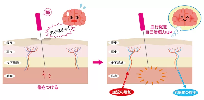 鍼の仕組み
